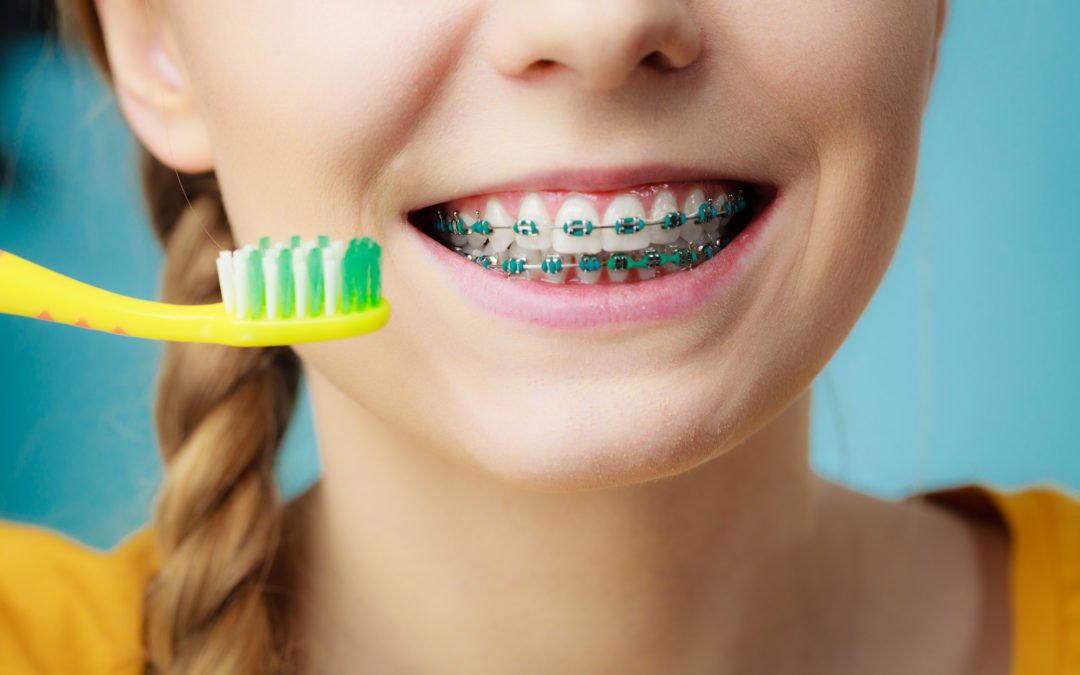 10 Things to Consider Before Getting Braces