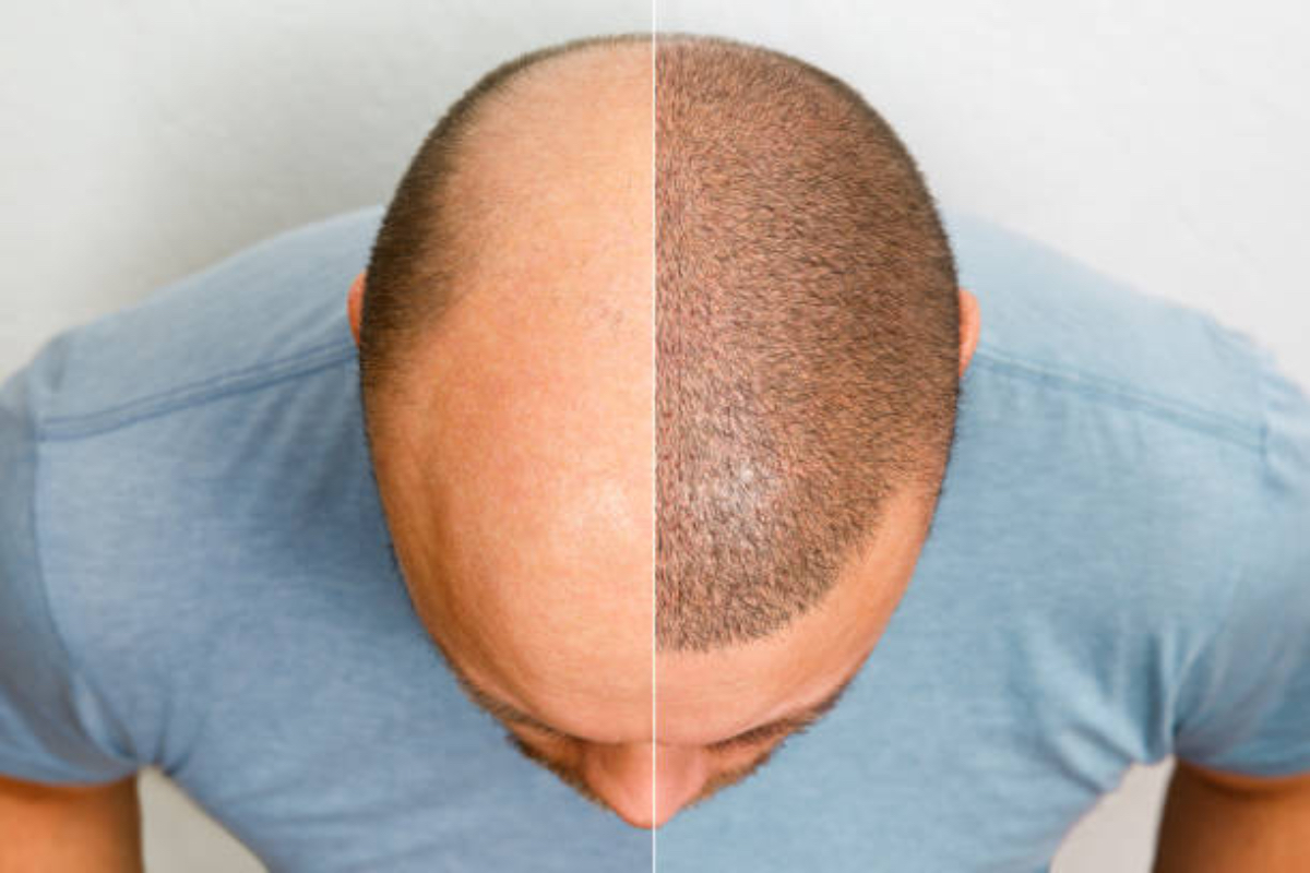 Would You Fly Abroad for a Hairline? Here’s Why Many Are Doing It