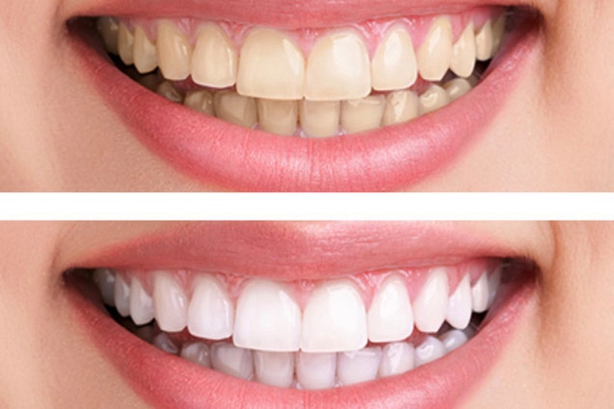 What Beauty Editors Miss When They Talk About the Smile